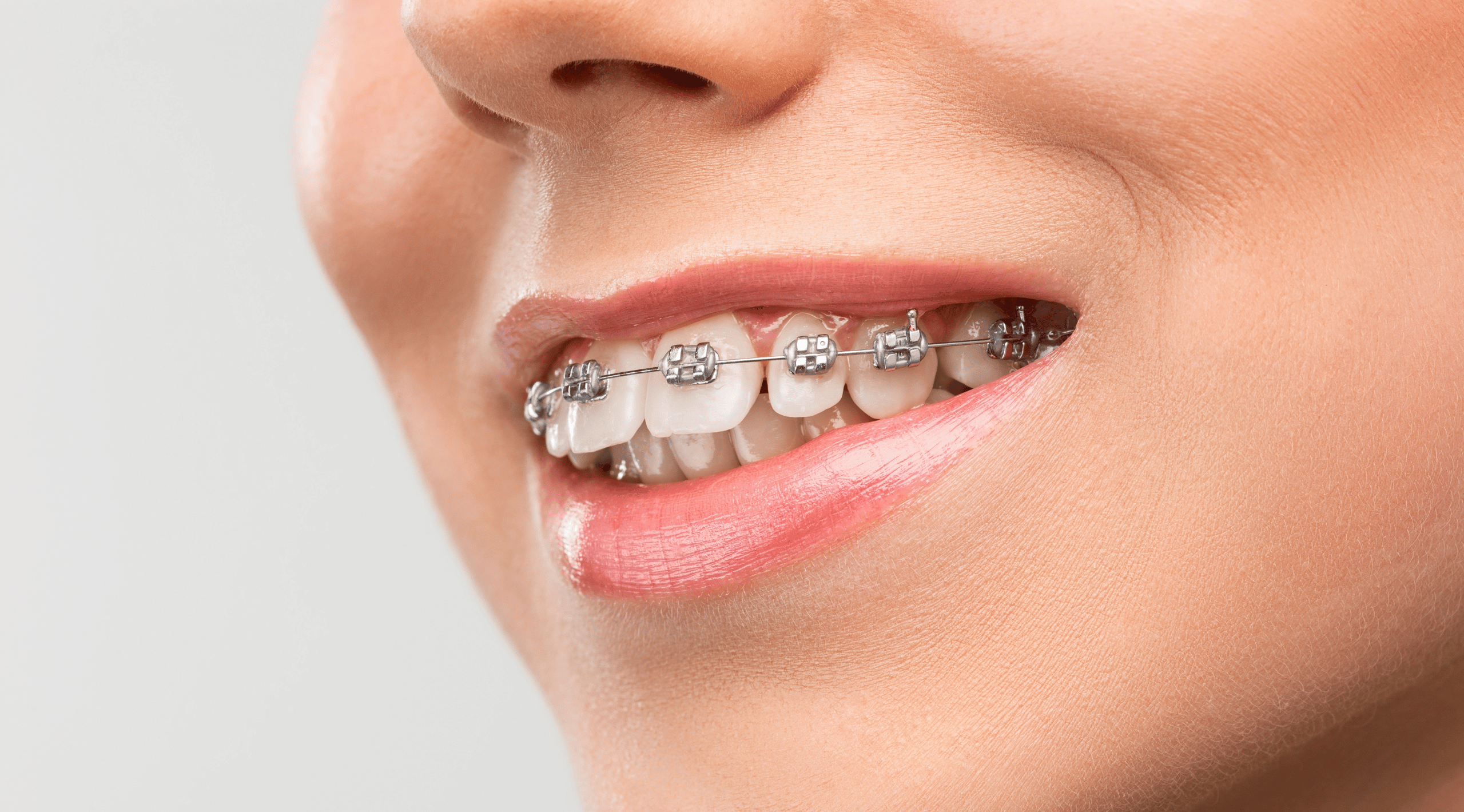 Orthodontic Treatment